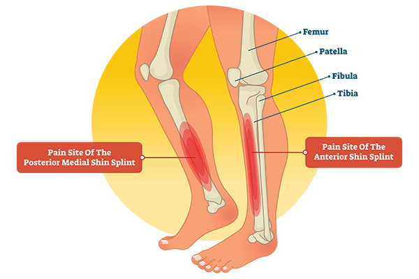 Picture of Leg Anatomy with Shin Splint Illustration | Shin Splits
