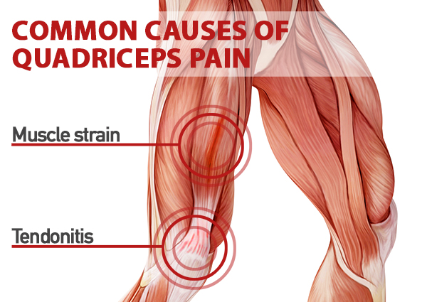 causes of quad pain | quad muscles