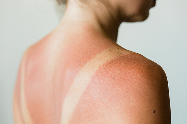 7 Causes of Itchy Skin in the Summer