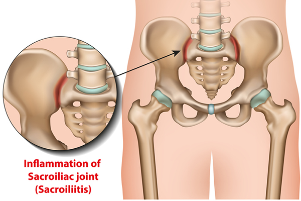 Mona Lisa Tegne nedenunder SI Joint Pain? Here's What to Do (and What NOT to Do) | BODi