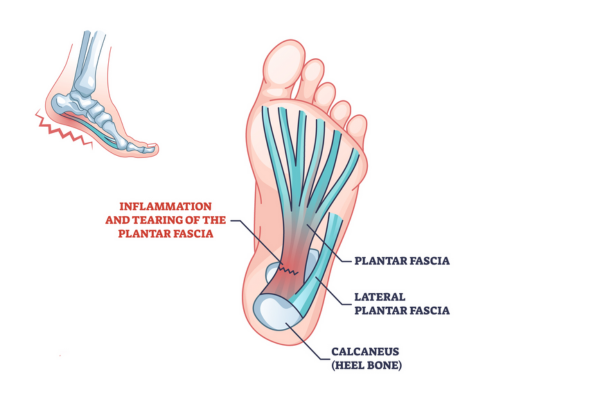 plantar fasciitis